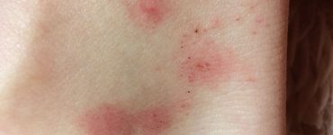 Аллергия на укус блохи - картинка 15