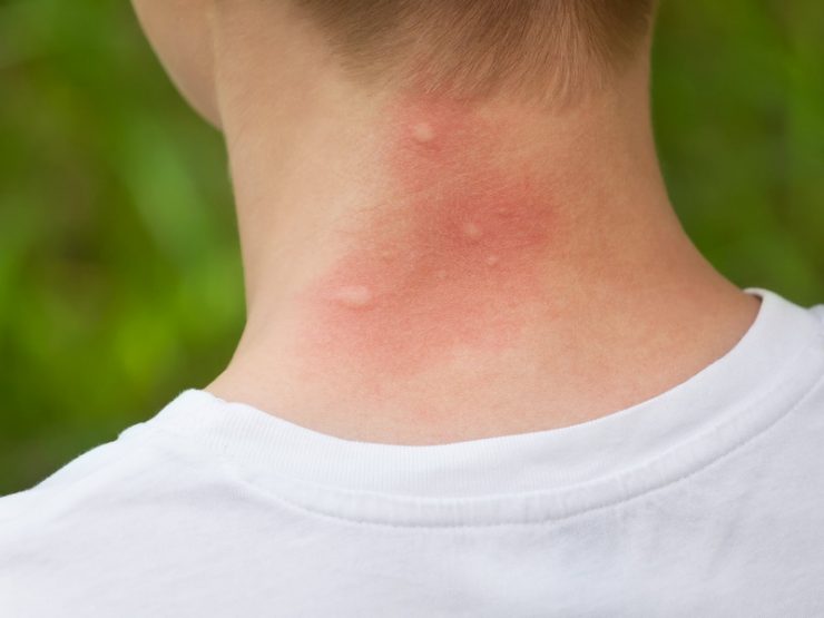Аллергия на мошек лечение - картинка 1