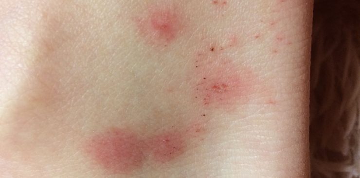 Аллергия на укус блохи - картинка 1