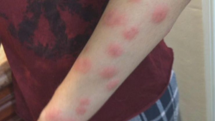 Аллергия на укусы клопов - картинка 1