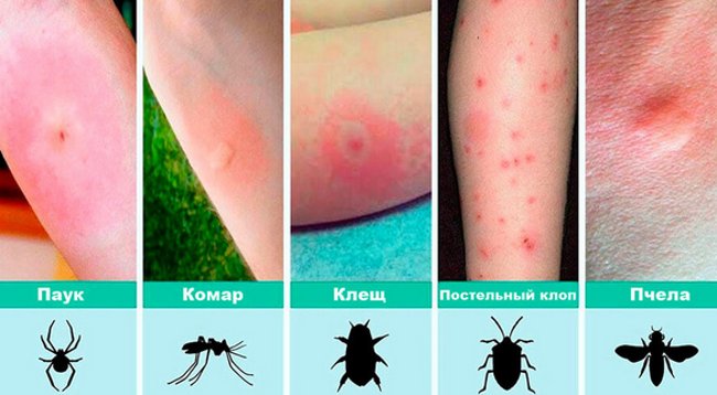 Что делать при укусе комара - картинка 1