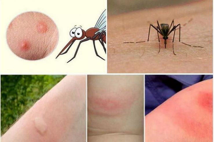 Как избавиться от укусов комаров - картинка 1