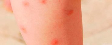 Как отличить укус клопа от укуса комара - картинка 38