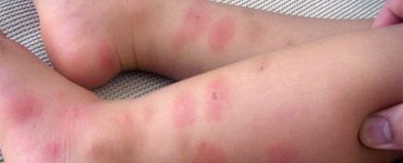 Сильные укусы комаров у ребенка - картинка 38