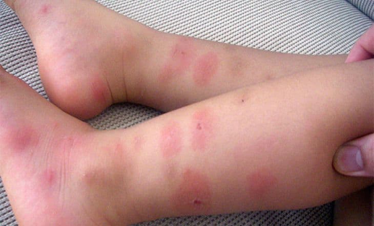 Сильные укусы комаров у ребенка - картинка 1